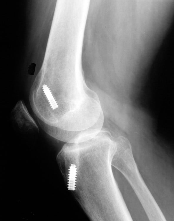Workers' Compensation Coverage For Nevada Knee Injuries